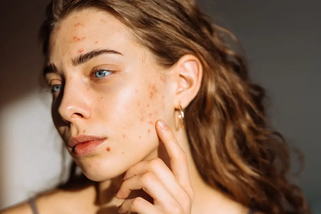 Vrouw met actieve acne op het gezicht